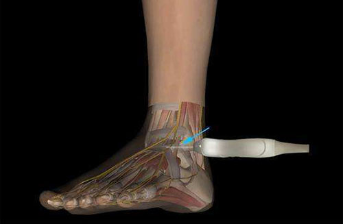 肌骨超聲:肌肉損傷超聲怎么看?